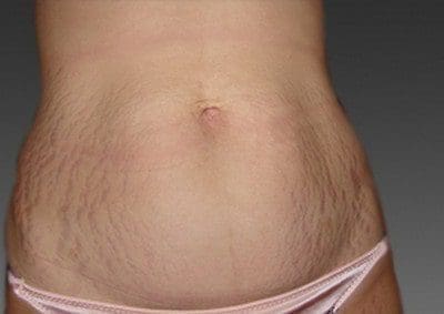 estriaS gravidez saúde nutrição beleza pele